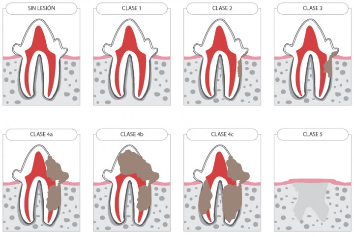 <p>Clasificación del Colegio Americano de Odontología Veterinaria (AVDC) de las reabsorciones dentales por su gravedad y localización.</p>