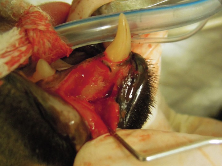 <p>Imagen intraquirúrgica de la extracción de 304. Se observa el colgajo mucoperióstico creado para facilitar la extracción de 304.</p>