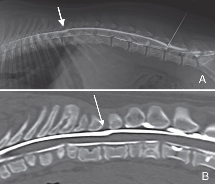 <p>A. Mielografía proyección lateral derecha del caso 3 en el que se aprecia una dilatación del espacio subaracnoideo dorsal, con acúmulo de contraste iodado y reducción del grosor de la médula espinal a nivel del cuerpo vertebral T12. B. Reconstrucción sagital con algoritmo hueso correspondiente a mielo-TAC del mismo caso. Se observan numerosas hemivértebras y vértebras en mariposa en los segmentos vertebrales adyacentes a la cavitación.</p>
