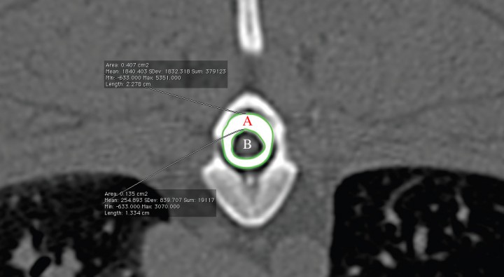<p>Mielo-TAC en corte transverso, con algoritmo hueso del caso 9 para la determinación del grado de compresión medular relativa en el punto de máxima compresión. A. Área del espacio subaracnoideo. B. Área medular.</p>