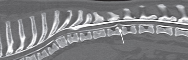 <p>Reconstrucción sagital de mielo-TAC del caso 5 con algoritmo hueso donde se observa una protrusión discal en T12-T13 (flecha) cercana al lugar de la cavitación leptomeníngea.</p>