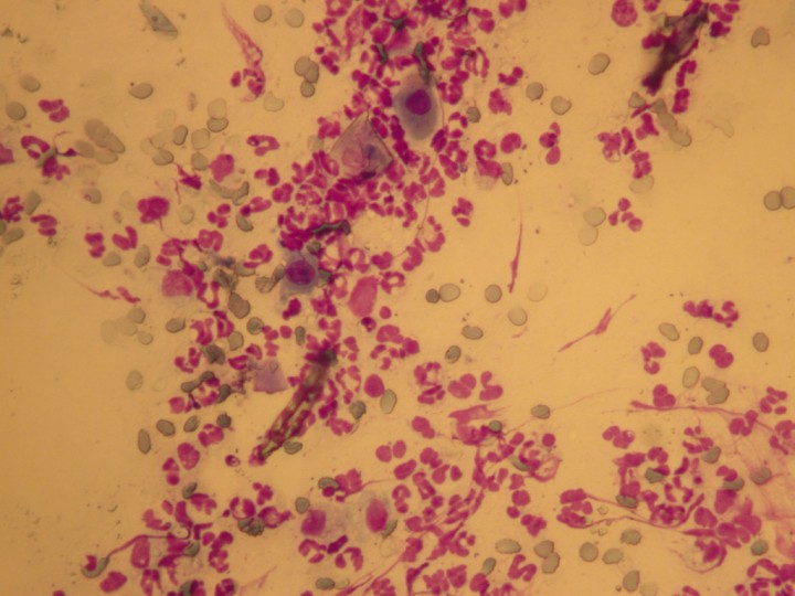 <p>Citología de pápulo-pústula (neutrófilos y células acantolíticas). Tinción panóptico rápido. 20x.</p>