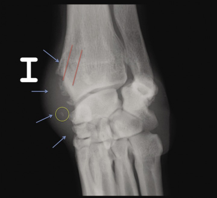 <p>Mismas radiografías que en la Figura 1A. En la proyección AP se observa la localización del surco radial (líneas rojas), el engrosamiento de tejido blando medial (flechas azules) y la opacidad hueso en el transcurso del tendón abductor <em>pollicis longus</em> (círculo amarillo).</p>
