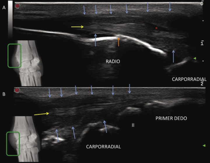 <p>Imagen ecográfica en corte longitudinal mostrando el recorrido del tendón abductor <em>pollicis longus</em> (flecha amarilla) sobre el radio distal (A) y el carpo-metacarpo medial (B) donde se inserta sobre el primer metacarpiano. Obsérvese el engrosamiento de la vaina tendinosa (flechas azules), la proliferación ósea cortical (flecha roja) y la efusión peritendinosa (*).</p>