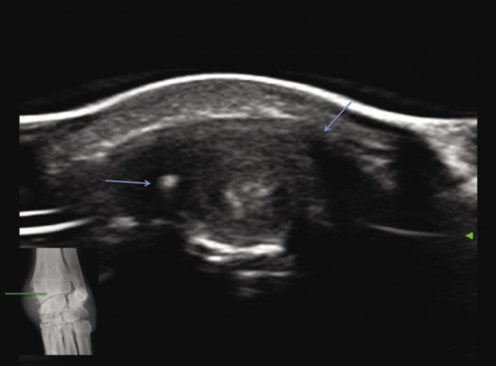 <p>Imagen en corte transversal del radio distal donde se aprecia neoformación ósea periférica (flechas azules) al surco por donde discurre el tendón tendón abductor <em>pollicis longus</em> y su vaina, marcadamente engrosada.</p>
