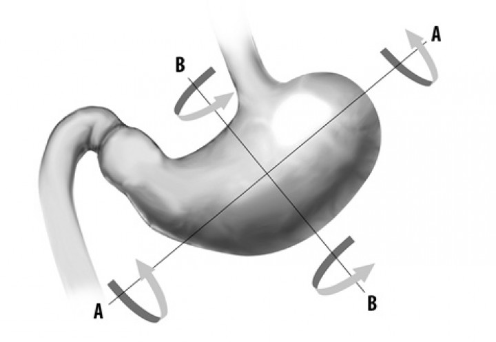 <p>Representación esquemática de los tipos de vólvulo gástrico: (A-A) sobre el eje longitudinal y (B-B) en el eje transversal.</p>
