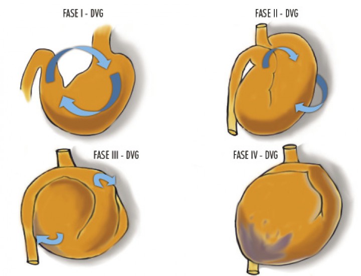 <p>Esquema de la rotación del estómago sobre su eje transversal, observándose un desplazamiento del píloro y duodeno proximal hacía ventral y craneal (Fase I y II) y produciéndose un cambio de posición del píloro a una localización dorsal y hacia el lado izquierdo del animal (Fase III y IV).</p>