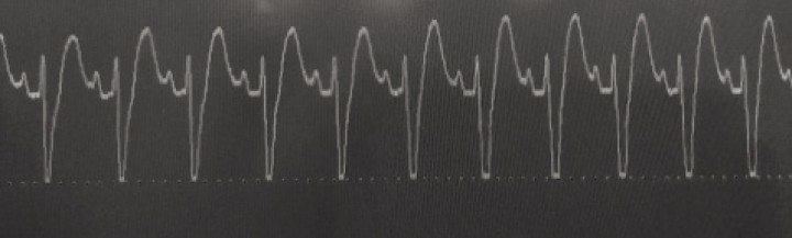 <p>Imagen de un electrocardiograma en un paciente con DVG en el que se observa taquicardia ventricular caracterizada por una ausencia de ondas P (o, si se ven, no siempre preceden inmediatamente a un QRS) y anchos complejos QRS.</p>