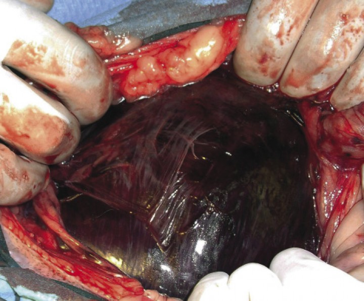 <p>Imagen intraoperatoria en un animal con DVG, en el que se evidencia un color anormal de la pared gástrica, indicativo de isquemia y necrosis del estómago (Imagen cedida por Manuel Jiménez Peláez).</p>