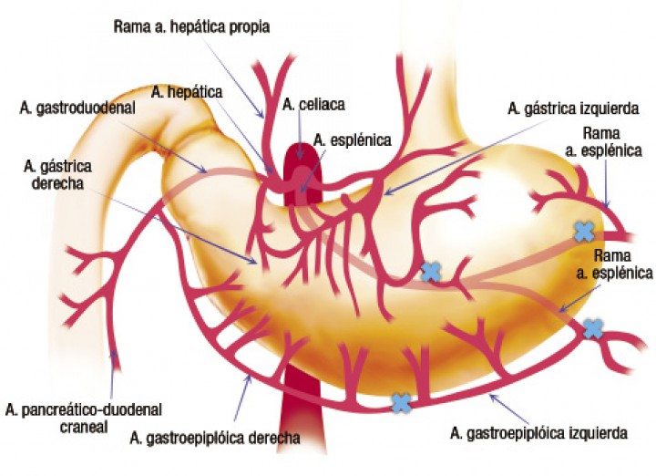 <p>Esquema representativo de la vascularización del estómago, estando marcados con (X) los vasos sanguíneos que con más frecuencia se dañan durante la DVG.</p>