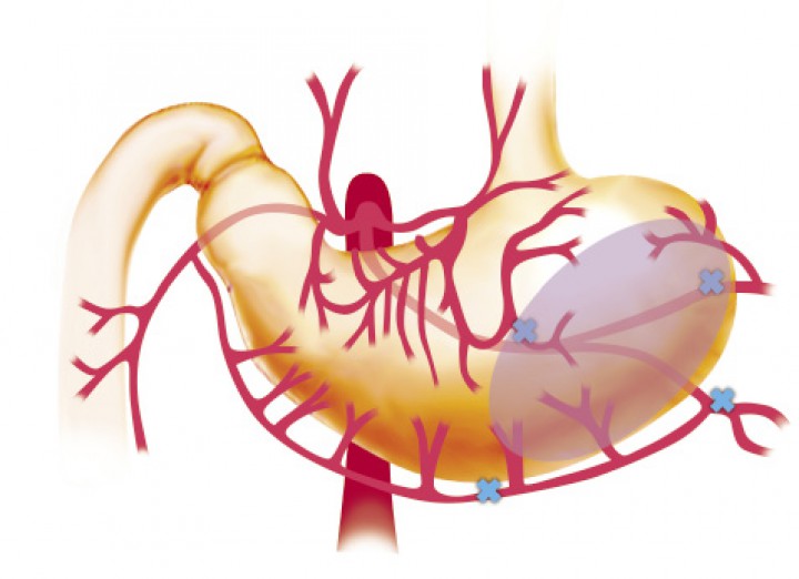 <p>Esquema representativo de la zona en la que con mayor frecuencia se puede observar la necrosis de la pared gástrica.</p>