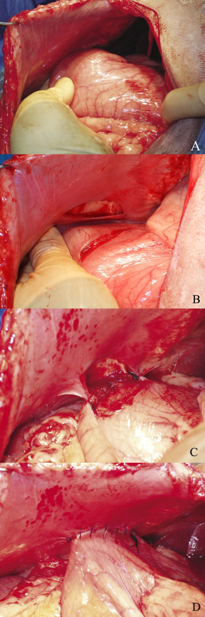 <table class=\"table table-bordered table-condensed table-hover table-striped\">
	<tbody>
		<tr>
			<td> </td>
			<td>
			<div class=\"Basic-Text-Frame\">
			<p>Secuencia de realización intraoperatoria de la gastropexia incisional. A. Localizar en la pared abdominal derecha la zona donde realizar la gastropexia, aproximadamente a 2-3 cm caudalmente a la última costilla y aproximar la zona del antro pilórico, para confirmar que la posición de la gastropexia es anatómicamente correcta. B. Realizar una incisión de unos 4 cm sobre la serosa de la pared abdominal y del estómago en su porción cercana al antro pilórico. C y D. Realizar la sutura de ambos bordes de la incisión por independiente, con un patrón de sutura continuo simple (Imágenes cedidas por Manuel Jiménez Peláez).</p>
			</div>
			</td>
		</tr>
	</tbody>
</table>