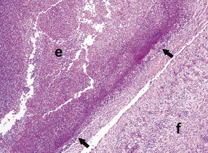 <p>Imagen microscópica del pericardio. Se observa una zona amplia de necrosis e inflamación supurativa (e) rodeada por una empalizada de macrófagos y células gigantes multinucleadas (flechas) y fibrosis (f). (Hematoxilina-Eosina x10).</p>