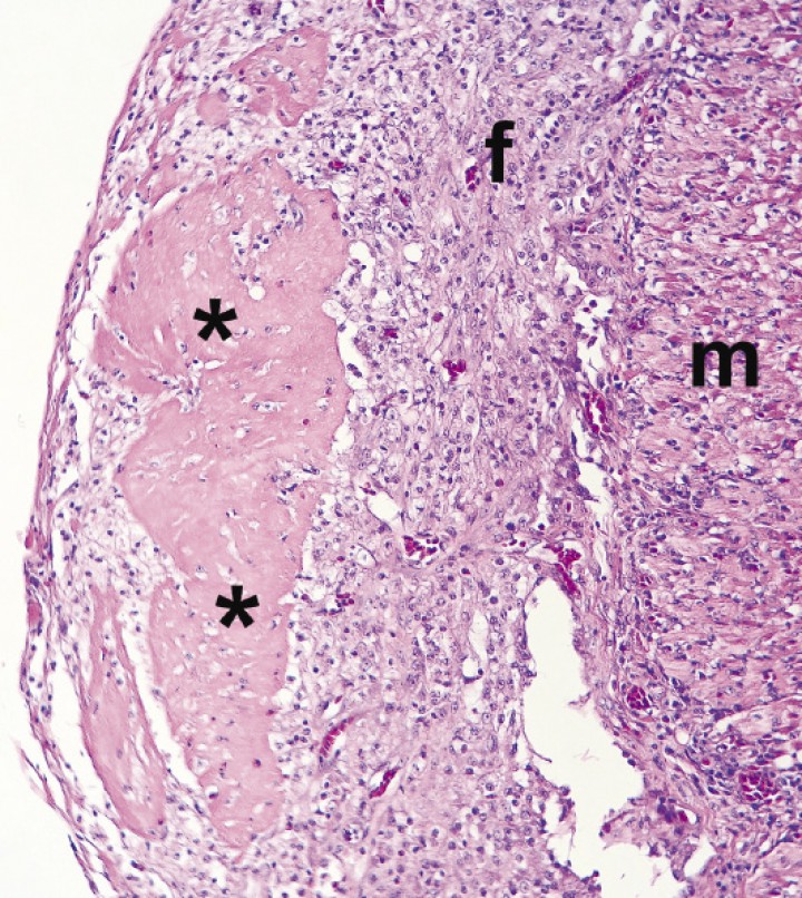 <p>Imagen microscópica del epicardio. El pericardio visceral está engrosado debido a depósitos de fibrina (asteriscos) rodeados de tejido conjuntivo fibroso (f). m = miocardio. (Hematoxilina-Eosina x20).</p>