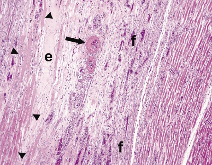 <p>Imagen microscópica del músculo esquelético pectoral. En la imagen se aprecia una zona de rabdomionecrosis (cabezas de flecha), rodeada por edema proteináceo (e), en zonas de pérdida de miocitos; dos arterias adyacentes muestran engrosamiento de su túnica media por depósitos de material fibrinoide (flecha). En el margen de esta lesión se observa fibrosis (f). (Hematoxilina-Eosina x10).</p>