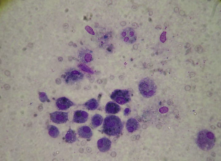 <p>Citología del nódulo. Presencia de gránulos de tirosina en el citoplasma celular. Diff Quick, x100.</p>