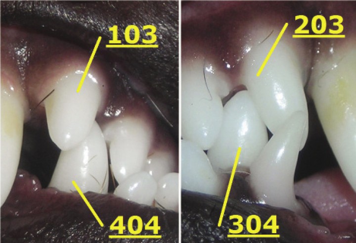 <p>Imágenes aumentadas de la Figura 1. Se observan los incisivos superiores laterales y caninos inferiores y su denominación. Se puede apreciar cómo impactan dichas piezas al ocluir.</p>