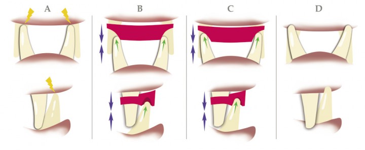 <p>Esquema de la secuencia de un tratamiento ortodóncico usando un plano inclinado para resolver una lingualización de caninos inferiores (se han obviado las demás dientes). A. Previo al tratamiento. Los caninos inferiores impactan con la encía maxilar (flechas amarillas). B. Comienzo del tratamiento, se encuentra el plano inclinado (en rojo) adherido a los caninos superiores. Los caninos inferiores, al ocluir, contactan lingualmente con los surcos tallados, y las fuerzas de oclusión (flechas azules) promoverán el movimiento ortodóncico hacia vestibular (flechas verdes). C. Se ha producido un movimiento hacia vestibular de los caninos inferiores. D. Una vez finalizado el tratamiento y retirado el plano inclinado, los caninos inferiores han corregido su desviación y la oclusión es correcta.</p>