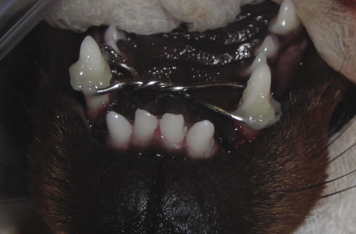 <p>Imagen fotográfica de la fabricación del plano inclinado en el propio paciente. Momento en el que se ha adherido el cerclaje en 8 (sin tensión), con composite, a los caninos superiores, paso previo a la aplicación de la resina bisacrílica que formará el plano inclinado.</p>