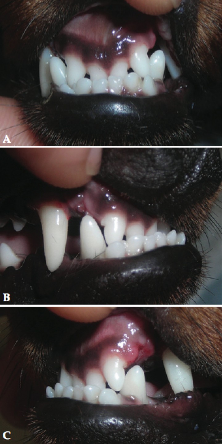 <p>Imágenes fotográficas tomadas al retirar el dispositivo. A. Vista frontal. B. Vista lateral derecha. C. Vista lateral izquierda. Los caninos inferiores ya no impactan con ningún diente ni con la encía superior. Se puede apreciar la ligera inflamación de la encía, producida por los restos de comida acumulados, y la zona de cicatrización de las exodoncias realizadas 15 días antes.</p>