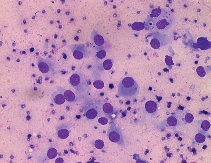 <p>Imagen citológica de osteosarcoma. Se observan células desde redondeadas u ovaladas a fusiformes. Pleomorfismo nuclear y vacuolización moderados. Obsérvese célula binucleada. Tinción Wright (100x).</p>