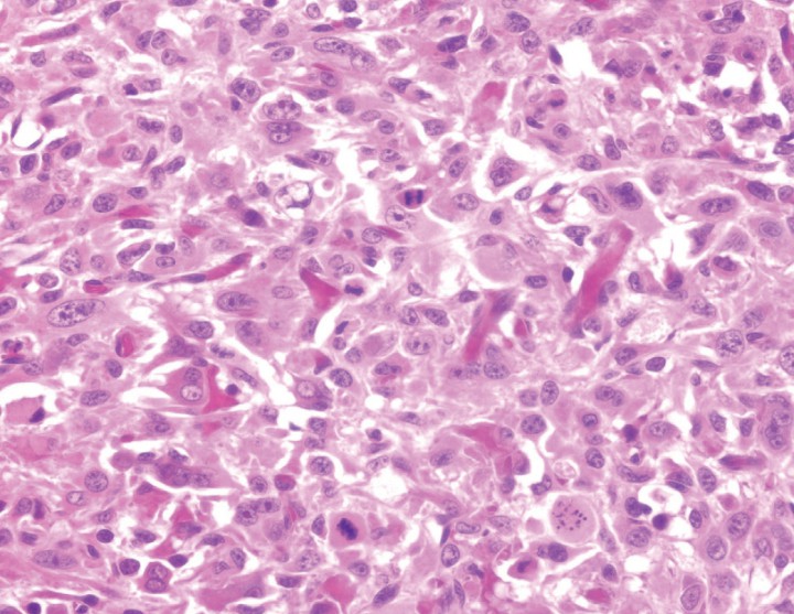 <p>Imagen histopatológica de osteosarcoma. Obsérvese población densa de células fusiformes mostrando atipia nuclear y producción de osteoide. Tinción hematoxilina-eosina (40x).</p>
