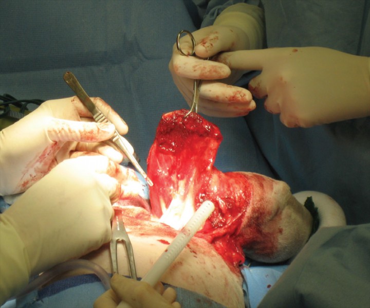 <p>Amputación del miembro tóracico derecho incluyendo la escápula. Obsérvese la escápula sujetada por las pinzas de Backhaus.</p>