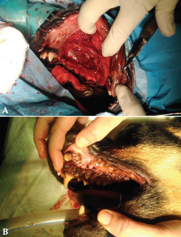 <p>(A) Imagen quirúrgica donde se aprecia la cavidad nasal después de extirpar el tumor del maxilar. (B) Imagen quirúrgica después del procedimiento de sutura.</p>