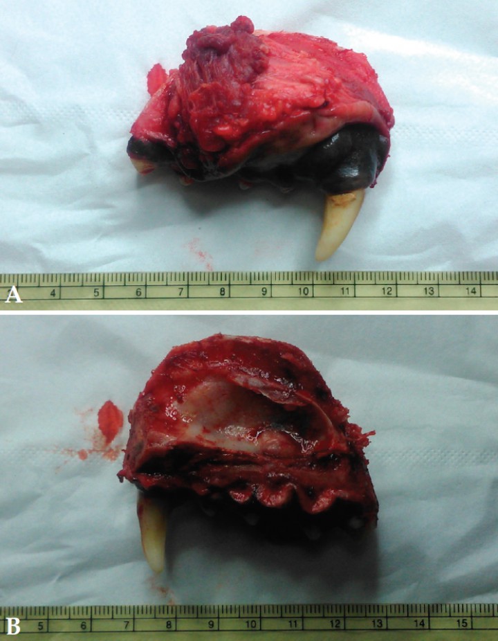 <p>Imagen macroscópica del tejido extirpado. (A) Vista oral. (B) Vista nasal.</p>