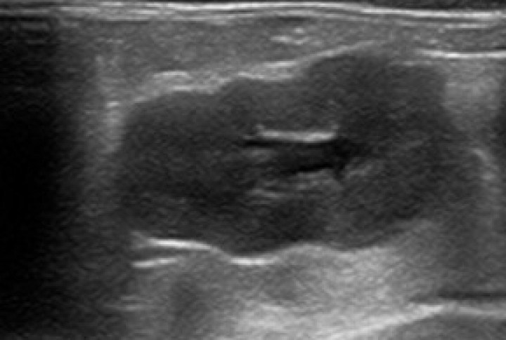 <p>Ecografía renal. Alteración de la arquitectura renal en un paciente diagnosticado de enfermedad aleutiana.</p>