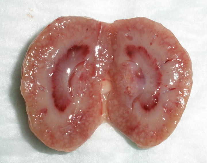 <p>Nefritis y nefromegalia en un paciente con coronavirus sistémico (sección renal).</p>