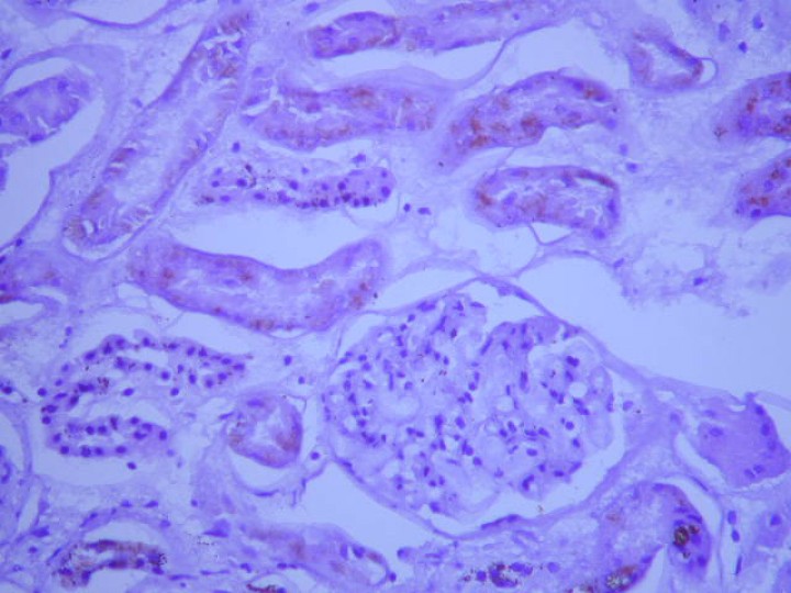 <div>
<div class=\"Basic-Text-Frame\">
<p>Imagen histopatológica (nefritis piogranulomatosa y linfoplasmocitaria con glomerulonefritis membranosa asociada). Tinción hematoxilina-eosina, 400 aumentos.</p>
</div>
</div>