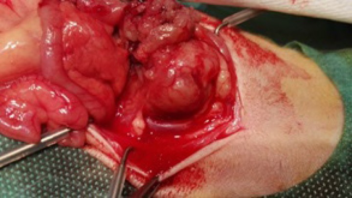 <p>Hemoabdomen (imagen intraquirúrgica) en hurón hembra de 6 años, con elevación de β-globulinas.</p>