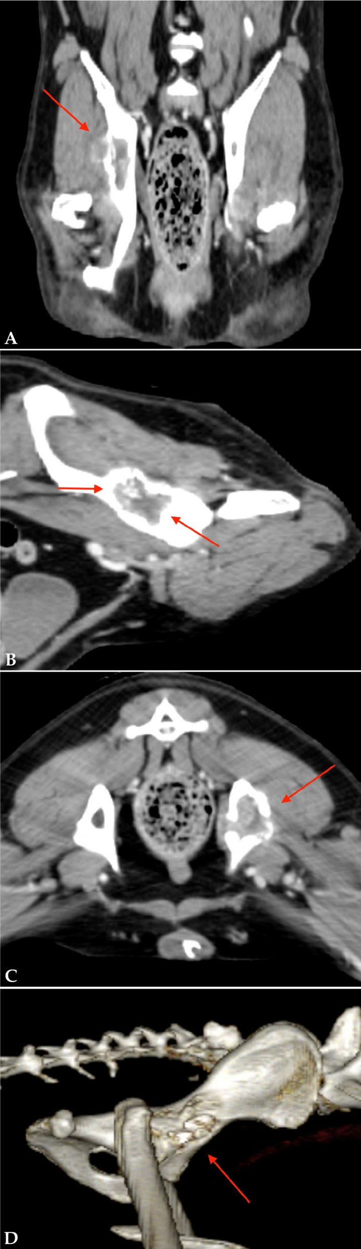 <p>(<strong>A</strong>) Imagen coronal del TC. (<strong>B</strong>) Imagen sagital del TC. (<strong>C</strong>) Imagen axial del TC. Se observa una lesión monostótica osteolítica y osteoproliferativa en el ilion, con afectación del acetábulo, compatible con neoplasia ósea primaria (flechas rojas). (<strong>D</strong>) Reconstrucción 3D de la lesión iliaca con afectación del acetábulo compatible con neoplasia ósea primaria.</p>