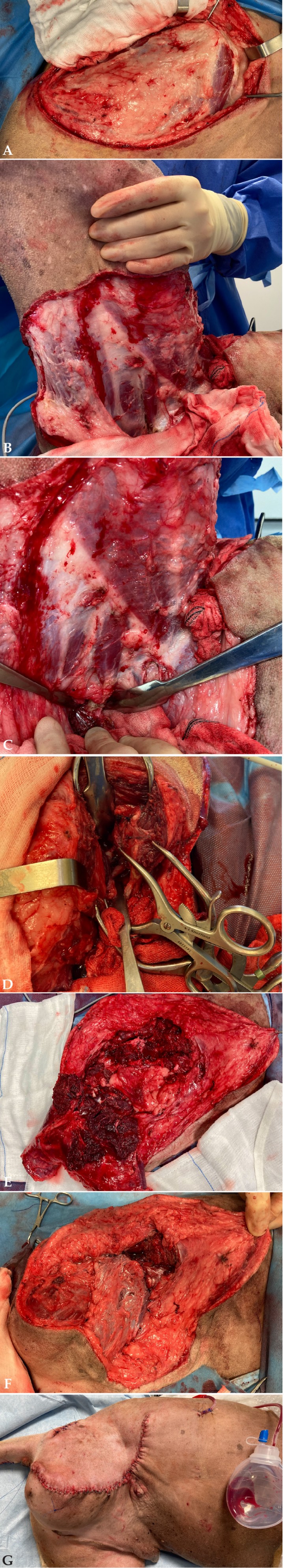 <p>(<strong>A</strong>) Incisión curvilínea lateral y exposición de los músculos pélvicos laterales. (<strong>B</strong>) Incisión curvilínea medial desde el pliegue inguinal al isquion, uniéndose a la incisión lateral previa. (<strong>C</strong>) Exposición del pecten del pubis. (<strong>D</strong>) Exposición de la articulación sacroilíaca. (<strong>E</strong>) Defecto quirúrgico tras la hemipelvectomía craneal externa. (<strong>F</strong>) Los músculos semimembranoso y semitendinoso fueron preservados para cerrar el defecto. (<strong>G</strong>) Cierre quirúrgico y colocación de drenaje Jackson Pratt.</p>
