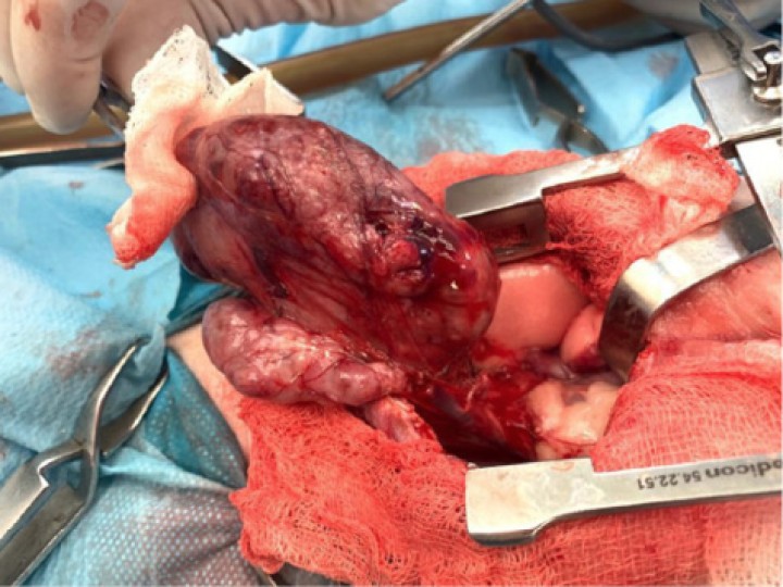 <p>Imagen de la masa mediastínica durante su extirpación quirúrgica.</p>