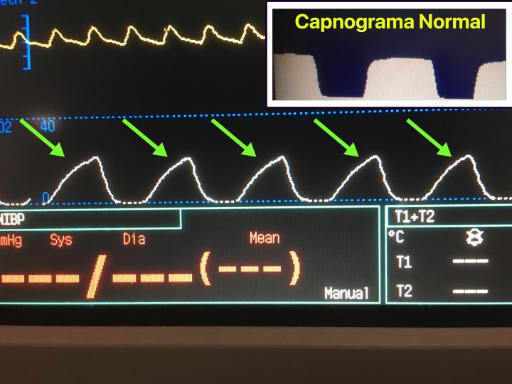 <div class=\"Basic-Text-Frame\">
<p><strong>Capnografía</strong>. Imagen de un capnograma de un gato al que se le está realizando un lavado broncoalveolar. Este animal comenzó con una onda de capnografía normal, pero evolucionó a un aumento del ángulo alfa y elevación de la meseta (también denominada “aleta de tiburón”, flechas verdes). Aunque el valor de capnografía no se observa en la fotografía, este se encuentra aproximadamente en 35 mmHg (normal entre 35-45 mmHg). Este cambio puede deberse a problemas como broncoespasmo, obstrucción parcial del tubo endotraqueal o enfisema, principalmente. En este caso, se introdujo una sonda para aspirar el tubo endotraqueal y se observó una mucosidad importante, por lo que se optó por retirar el tubo y volver a intubar al animal con uno nuevo de tamaño mayor.</p>
</div>
