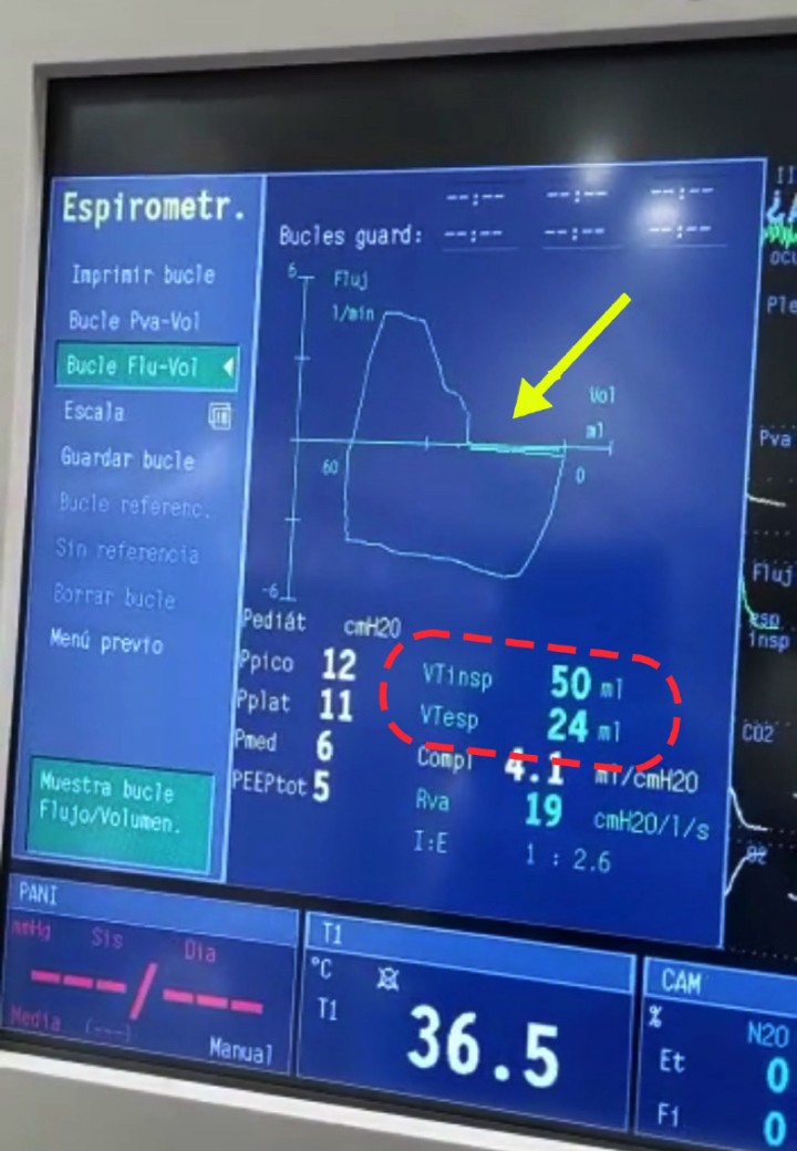 <p><strong>Espirometría</strong>. Imagen de un bucle de espirometría relacionando flujo y volumen en un gato respirando de forma espontánea durante una anestesia general. En esta gráfica se aprecia que el volumen inspirado es mayor que el espirado (cuadro rojo punteado), por lo que el bucle no se cierra (flecha amarilla) y representa una fuga. Es importante, una vez visualizado este problema, intentar averiguar si el problema está relacionado con que el neumotaponamiento se ha roto o se ha podido incluso mover. En este caso, se deshinchó el sistema de neumotaponamiento, se recolocó el tubo endotraqueal, se volvió a hinchar el sistema de neumotaponamiento y la fuga se eliminó, observándose de nuevo un bucle completamente cerrado.</p>
