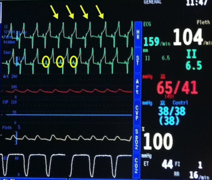<p><strong>ECG</strong>. Una de las razones por la que debemos tratar las arritmias ventriculares es si están comprometiendo la presión arterial. Pero cuidado, no todas las morfologías que estamos acostumbrados a ver como complejos ventriculares prematuros realmente lo son. En este perro se observan unos complejos ventriculares de forma ancha (flechas amarillas), similares a los que se observan en un ritmo ventricular, pero en este caso un análisis más detallado nos permite observar que todos esos complejos ventriculares están precedidos de una onda “P” (círculos amarillos). Esto transforma nuestro diagnóstico en un ritmo sinusal con bloqueo de rama, por lo que si queremos tratar la hipotensión debemos buscar otra causa.</p>