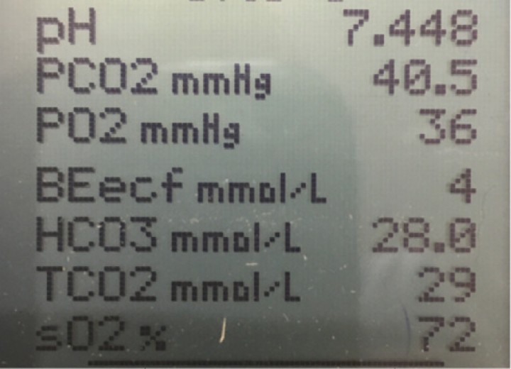 <p><strong>Gasometría</strong>. Gasometría de sangre arterial durante una extirpación de un lóbulo pulmonar. En ese momento, la presión arterial media tenía un valor de 50 mmHg (valores normales por encima de 60 mmHg). Como se observa en la imagen, la ventilación está bien (valor de PaCO<sub>2</sub> entre 35-45 mmHg) pero la PaO<sub>2</sub> muestra hipoxemia grave (valores por debajo de 60 mmHg). Vemos en el campo quirúrgico que los pulmones no se expanden con facilidad y que hay zonas atelectásicas. Aunque deberemos optimizar la oxigenación y realizar un reclutamiento alveolar, es importante optimizar antes el sistema cardiovascular, debido a que el reclutamiento alveolar conlleva frecuentemente un descenso de la presión arterial.</p>