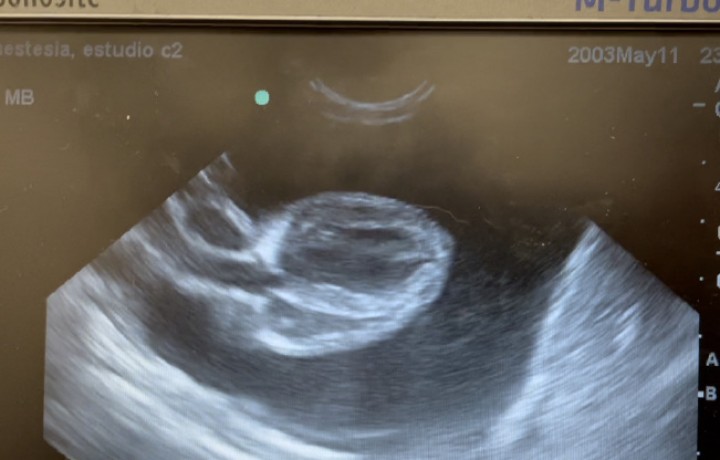 <p><strong>Ecografía</strong>. La hipotensión es una complicación común durante la anestesia. La utilización de ecografía puede ser de utilidad para descartar algunas de las diferentes causas, como puede ser una hipovolemia o una hipocontractibilidad miocárdica. En ocasiones podemos encontrar causas más infrecuentes, como en este caso en que se observa un taponamiento cardíaco por efusión pericárdica. En este paciente, el ECG realizado durante la monitorización anestésica también nos habría hecho sospechar al mostrar una alternancia eléctrica. El uso de ecografía durante la anestesia se está extendiendo cada vez más en veterinaria debido a que puede ayudarnos a diagnosticar el origen de complicaciones cardiovasculares y ventilatorias. En este caso, el drenaje y aumento de la volemia mejorará el estado cardiovascular del animal.</p>