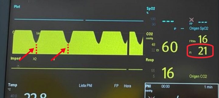 <p><strong>Capnografía</strong>. Esta es la capnografía que se observa en un perro de 50 kilos anestesiado con sevoflurano y utilizando un circuito circular. La curva de capnografía muestra una buena meseta, pero se aprecia que la fase inspiratoria no llega a cero (flechas rojas), por lo que se diagnostica una reinhalación de CO<sub>2</sub> (con una F<sub>i</sub>CO<sub>2</sub> de 21 mmHg, dentro del círculo rojo). Las principales causas de esta reinhalación durante la utilización de un circuito circular pueden incluir que las válvulas (inspiratoria o espiratoria) no funcionen adecuadamente, que el absorbente de CO<sub>2</sub> esté exhausto o que el flujo sea demasiado bajo. En este caso, aunque las válvulas funcionaban de forma correcta durante la revisión del circuito antes de anestesiar al animal, el vapor de agua que se ha ido generando durante la anestesia ha provocado que la válvula espiratoria permanezca abierta durante todo momento, por lo que el animal inspira la mezcla tanto de la parte inspiratoria, como de la espiratoria.</p>