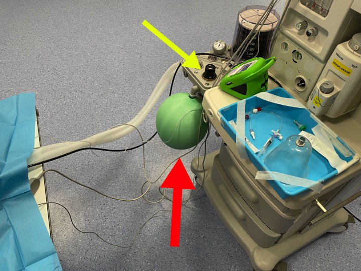 <div class=\"Basic-Text-Frame\">
<p><strong>Balón reservorio y válvula de sobrepresión</strong>. La apnea es una complicación que a veces puede aparecer durante anestesia general. Si el paciente está intubado no debería ser un problema, ya que lo podemos ventilar tanto de forma manual como mecánica, pero obviamente tenemos que intentar saber cuál es la causa de la apnea en nuestro paciente. Durante la anestesia general, un plano anestésico muy profundo, así como la administración intravenosa de ciertos fármacos (como fentanilo, ketamina, etc.) pueden provocar esta complicación anestésica. De todas formas, nunca tenemos que olvidar las posibles causas debidas al equipamiento anestésico, como ocurre en este caso. Si observáis, el balón reservorio está muy hinchado (flecha roja), alcanzando presiones en el circuito anestésico tan altas que el paciente no puede vencerlas y, por lo tanto, respirar. Esto ocurre al dejar cerrada o por un mal funcionamiento de la válvula de sobrepresión (pop-off) (flecha amarilla), que permite eliminar la presión sobrante del circuito anestésico. Por ello, siempre es importante revisar el equipo anestésico antes de comenzar una anestesia, y conocer qué componentes de nuestra máquina anestésica pueden producir complicaciones.</p>
</div>