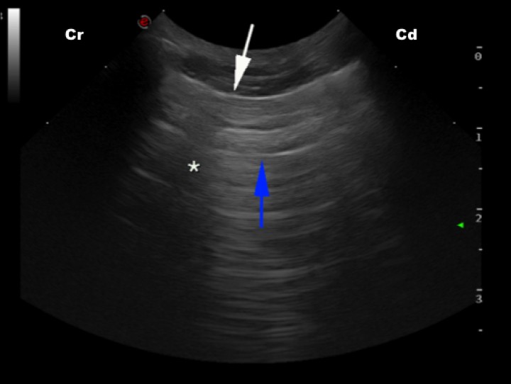 <p>Imagen ecográfica de pulmón de un paciente sano en la que se observa la línea PP (interfase pleura-pulmón) como una fina línea hiperecoica (flecha blanca), así como líneas A hiperecoicas y paralelas entre sí (flecha azul) y la sombra acústica generada por una costilla (asterisco). Cr: craneal; Cd: caudal.</p>