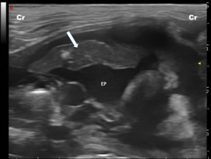 <p>Imagen ecográfica de un paciente con efusión pleural (EP) severa y consolidación pulmonar (flecha blanca) secundaria a la presión ejercida por el líquido sobre el lóbulo pulmonar. Cr: craneal.</p>