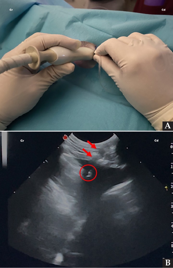 <p>(<strong>A</strong>) Colocación del transductor y de la aguja para la realización de un procedimiento de toracocentesis mediante el acceso caudal, en una técnica estéril para la obtención de líquido pleural. (<strong>B</strong>) Imagen ecográfica del procedimiento de toracocentesis mediante el acceso caudal, en la que se observa el trayecto de la aguja (flechas rojas) y la punta de la misma (círculo rojo) situada en el líquido a extraer. Cr: craneal; Cd: caudal.</p>