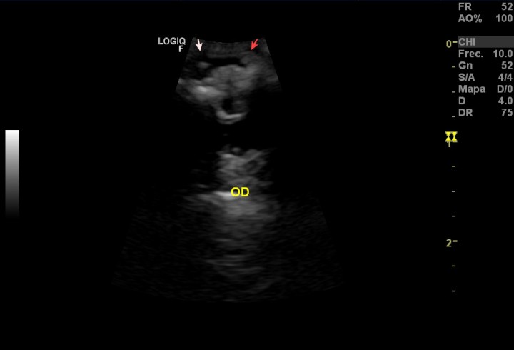 <p>Imagen de ecografía ocular (OD). Se aprecian dos masas en la cámara anterior (flechas), una de ellas en la zona del ángulo iridocorneal (flecha roja).</p>