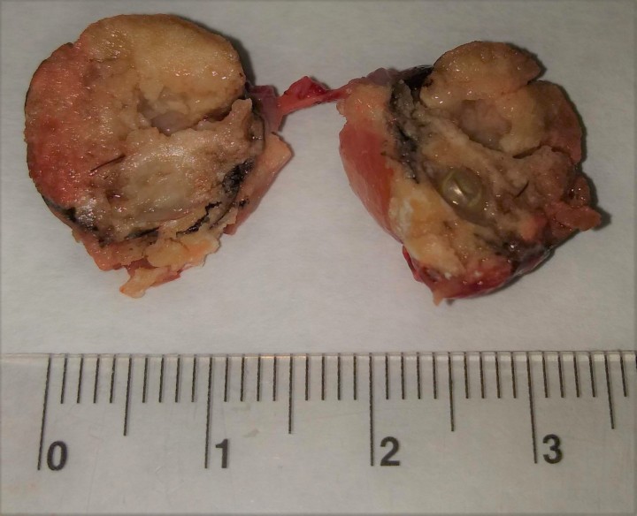 <p>Disección del globo ocular tras la enucleación. Las estructuras intraoculares se hallaban infiltradas de tejido calcificado no diferenciable.</p>