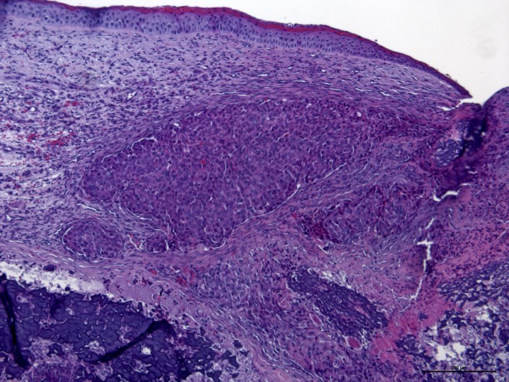 <p>Histopatología. Córnea invadida por un crecimiento sólido e infiltrativo de células neoplásicas que substituyen parcialmente el estroma corneal. El epitelio corneal presenta una marcada hiperqueratosis. H&E (x10).</p>