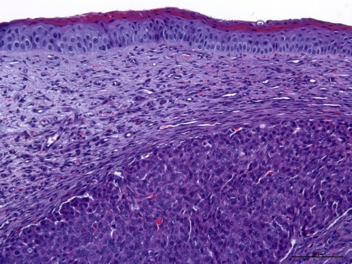 <p>Histopatología. En la córnea se observan algunas de las características citológicas de las células neoplásicas: morfología poligonal y fusiforme con bordes pobremente definidos, citoplasma de tamaño variable y eosinófilo, y núcleo central con un nucléolo evidente. El grado de anisocitosis y anisocariosis es moderado y el índice mitótico elevado, con algunas mitosis aberrantes. H&E (x20).</p>